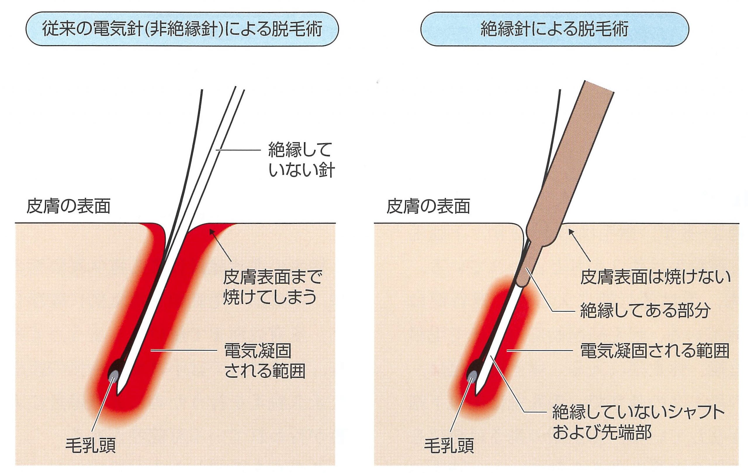 ニードル 脱毛 vio