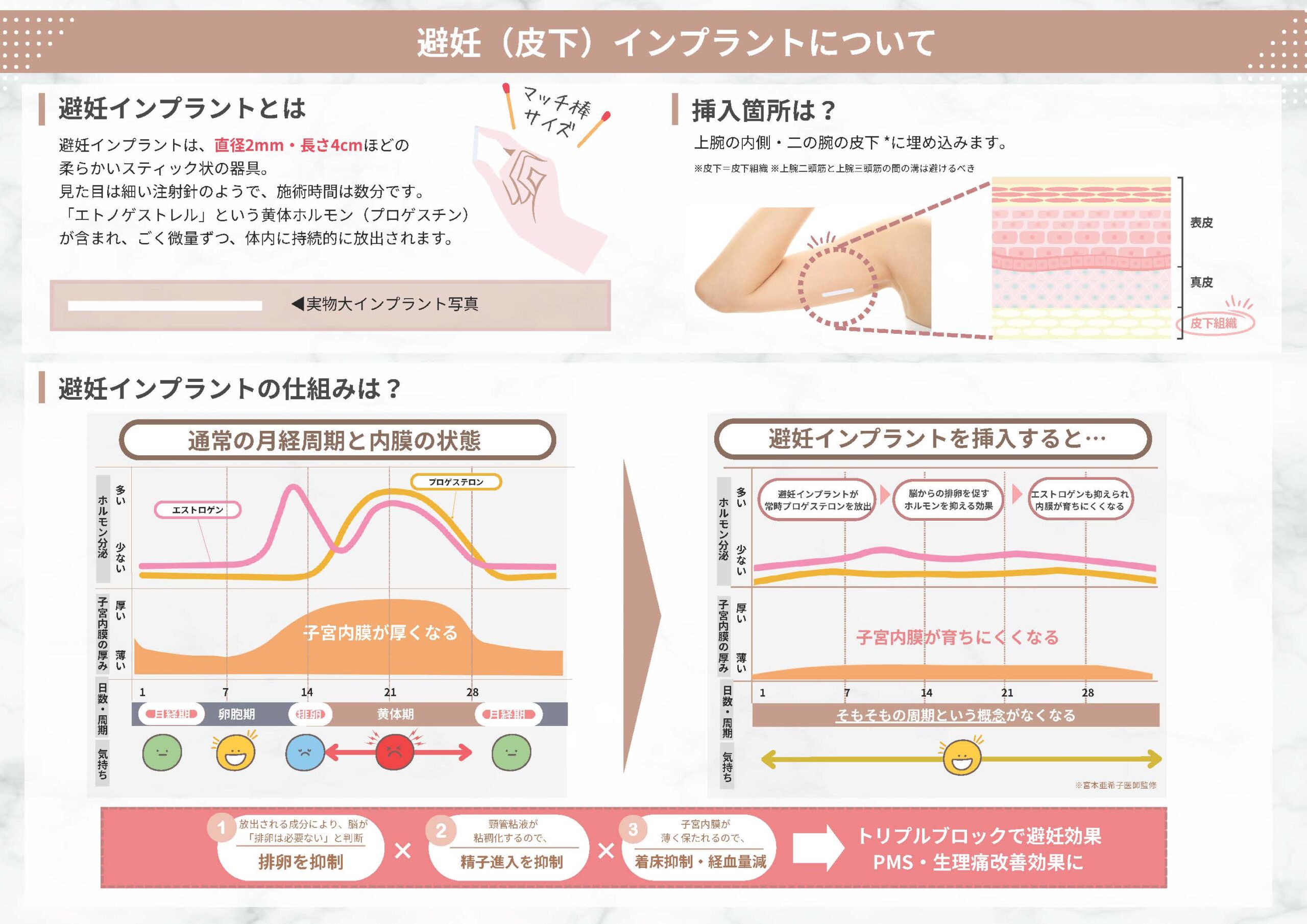 避妊インプラントの概要と仕組み