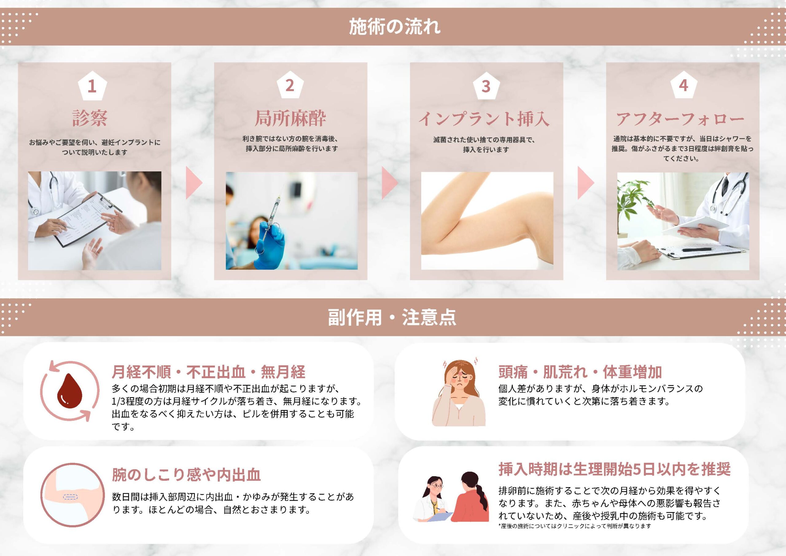 避妊用インプラント ネクスプラノン