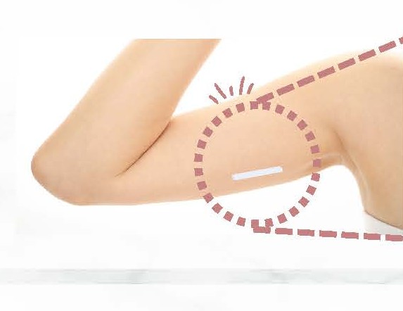 避妊インプラントを上腕に挿入するイメージ