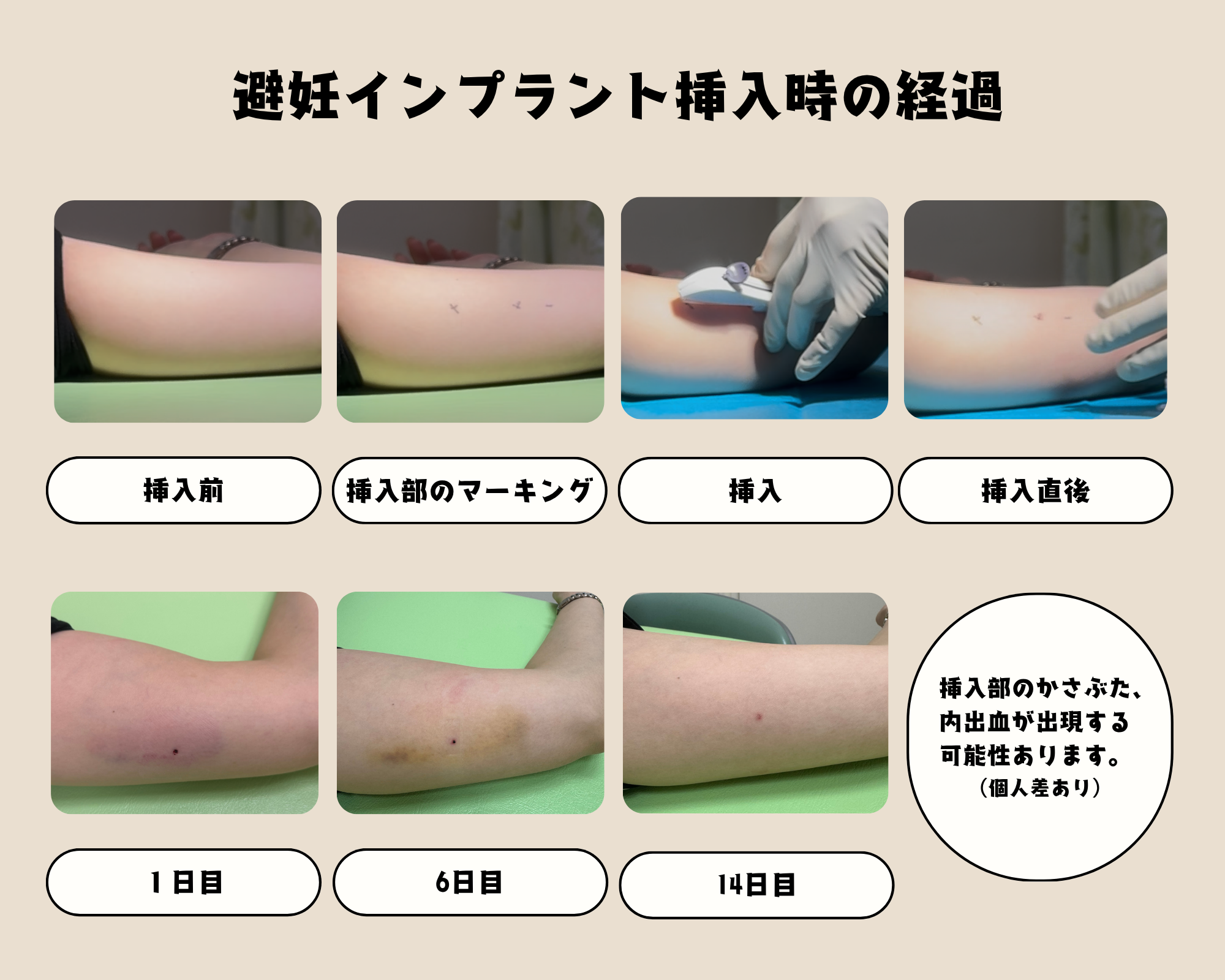 避妊インプラント挿入後の経過