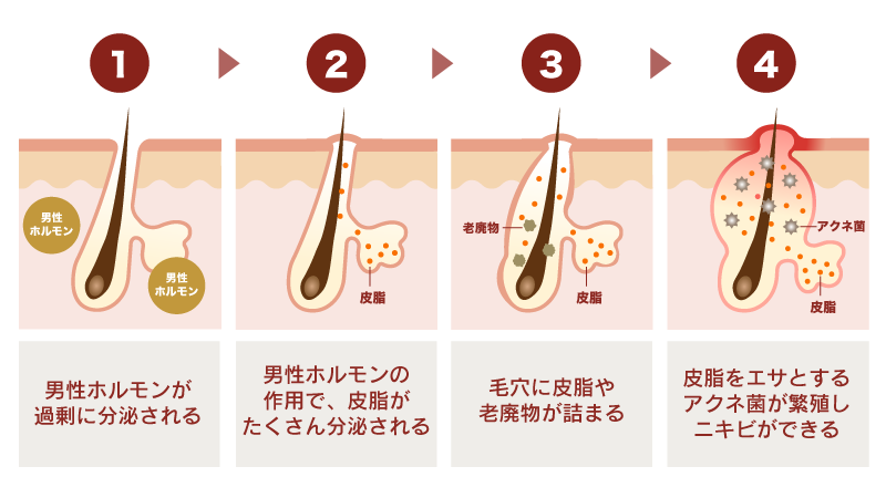 低用量ピルでニキビが減る・改善するのはなぜ？