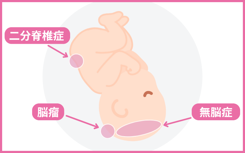 胎児の先天異常「神経管閉鎖障害」とは